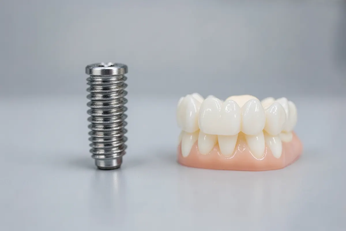 Comparação lado a lado de um implante dentário (parafuso de titânio) e uma prótese dentária (ponte fixa com dentes artificiais).