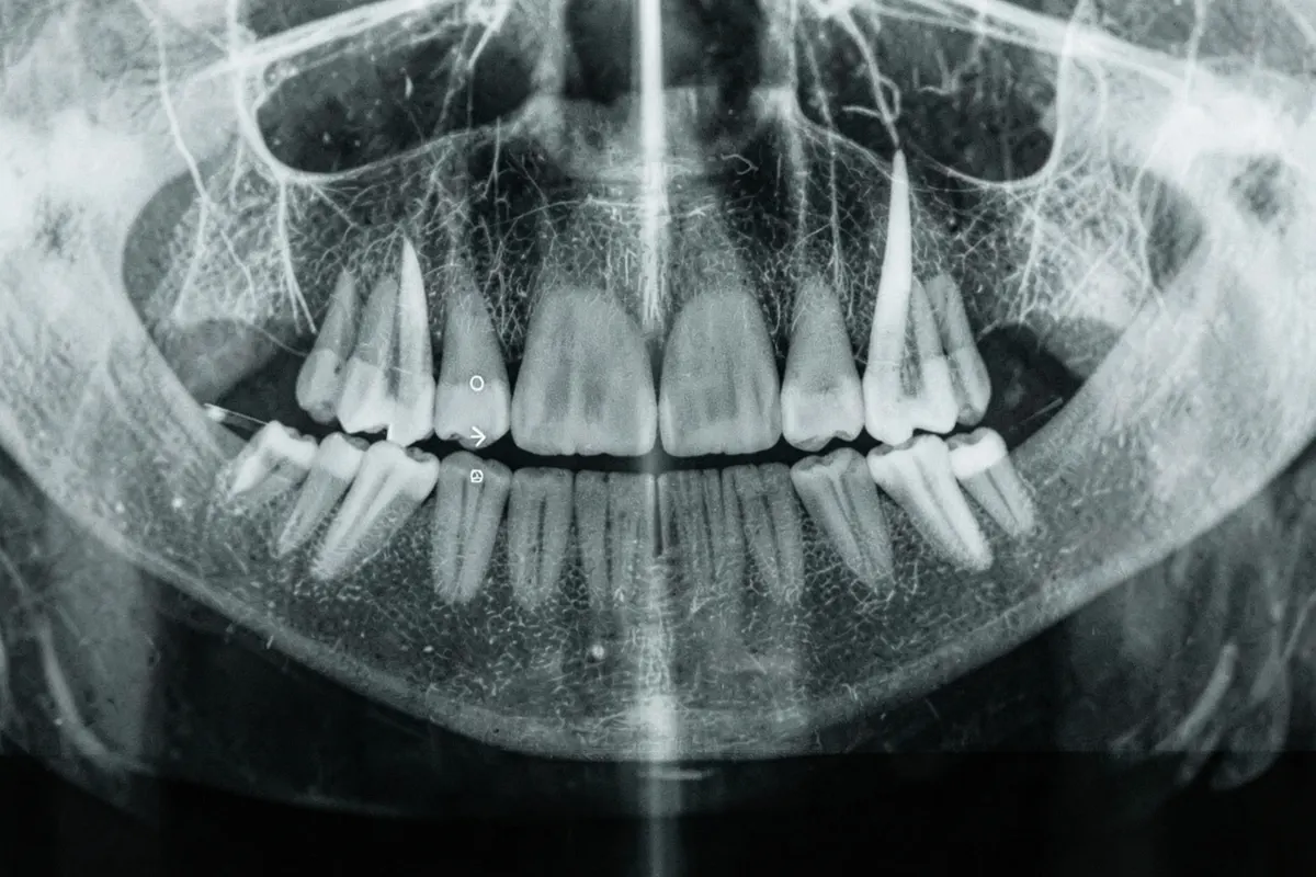 Radiografia panorâmica de uma arcada dentária com marcações indicando áreas de tratamento.