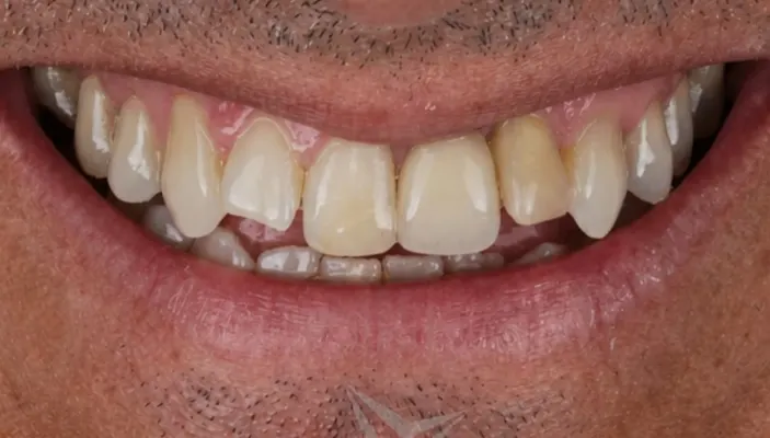 Close-up de um sorriso completo ANTES da reabilitação oral.