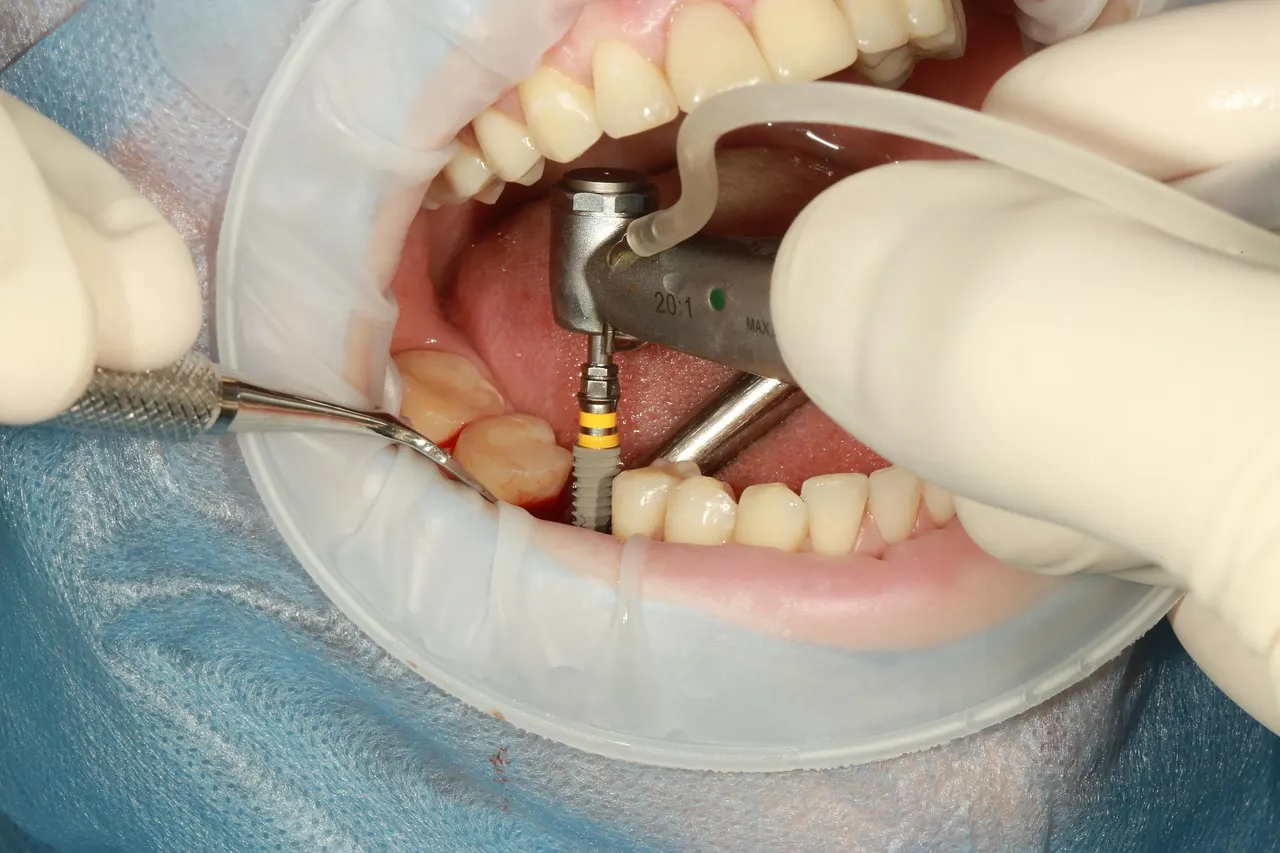 O que acontece com o seu sorriso ao fazer implante dentário após anos sem dente
