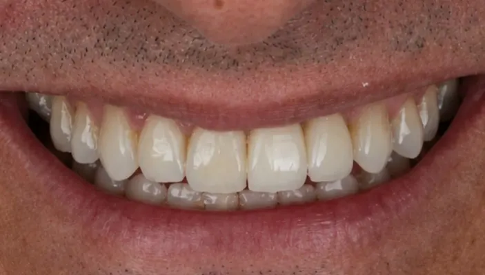 Close-up de um sorriso completo com dentes brancos e alinhados após reabilitação oral.